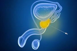 La ablación transperineal con láser mínimamente invasiva de la próstata parece ser eficaz